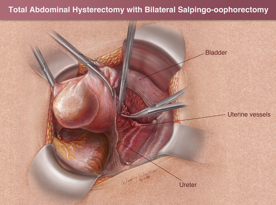 hysterectomy