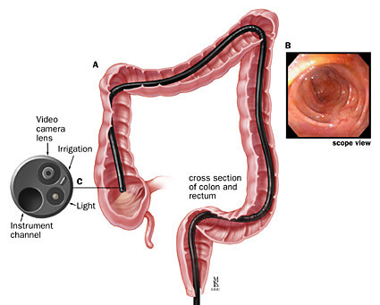 endoscopy