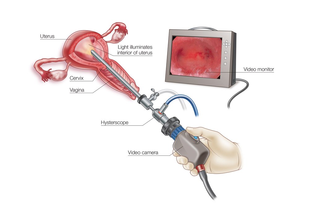 hysteroscopy